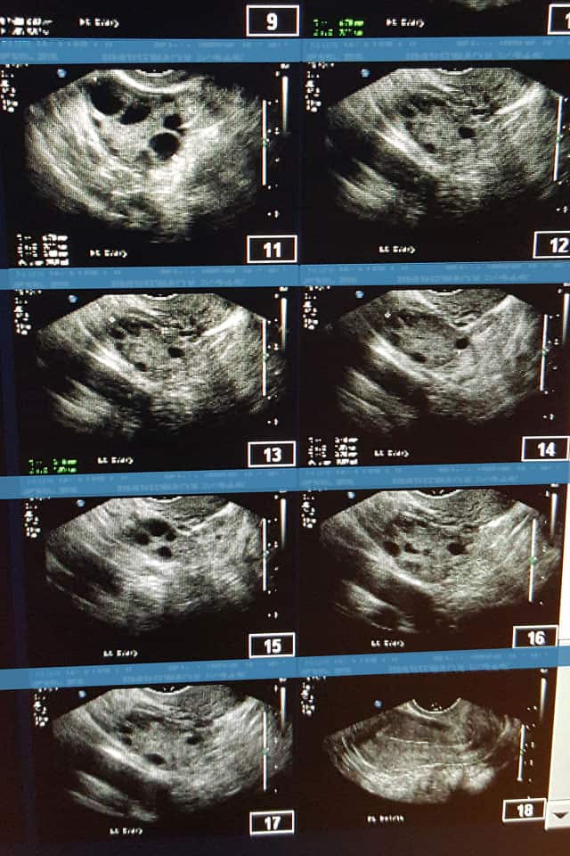 PCOS Ovaries (Polycystic Ovarian Syndrome)