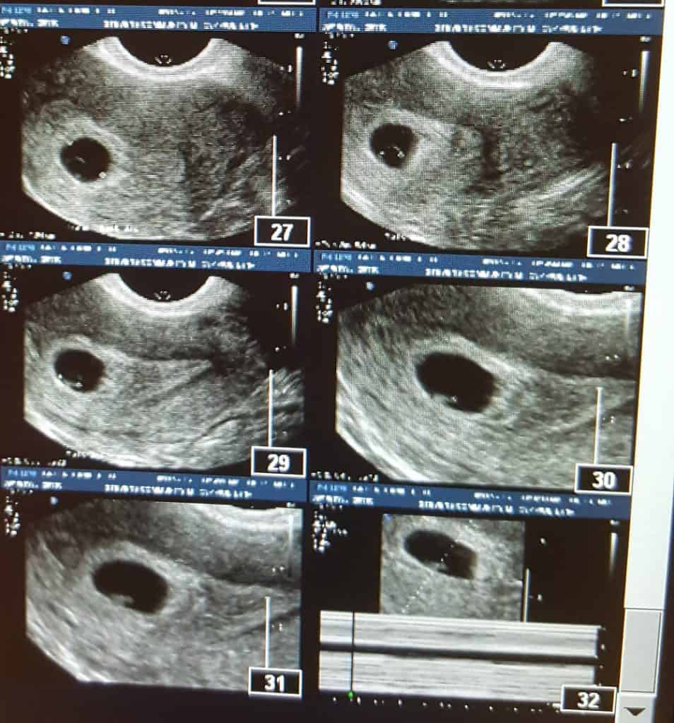 baby measuring small at 7 weeks ivf