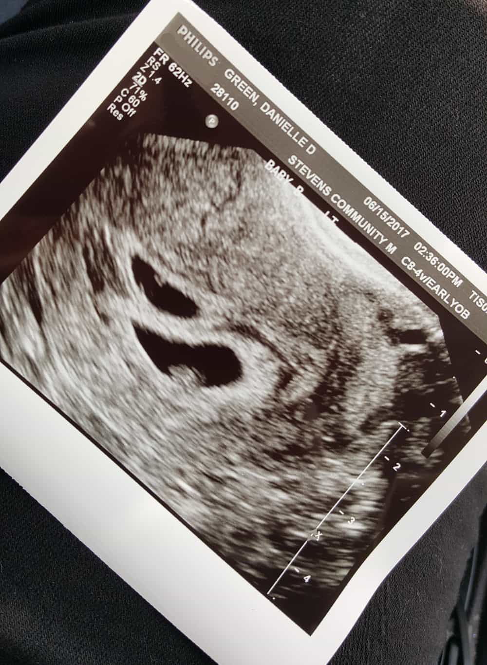 6 week ultrasound twins